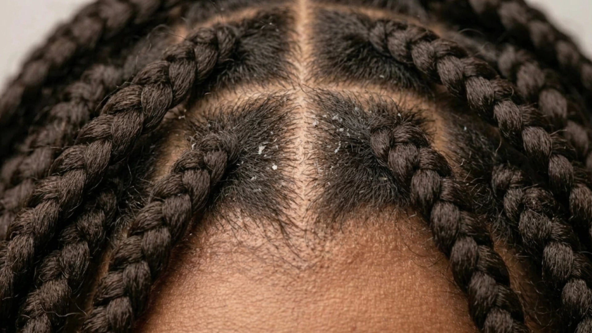Close-up of braided hair with visible scalp showing dandruff flakes along the part line.