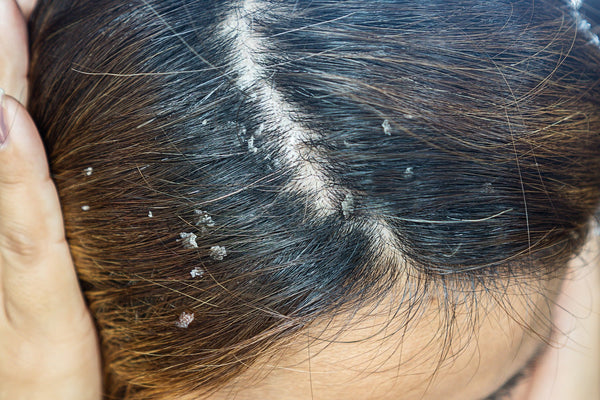 Stop the Flakes, Save your Hair: How to Prevent Dandruff-Related Hair Loss